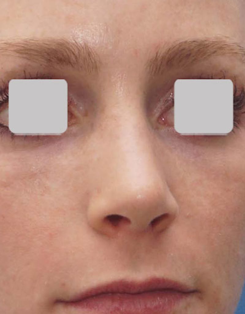 Favorite Revision Rhinoplasty Before & After Gallery - Patient 174327 - Image 4
