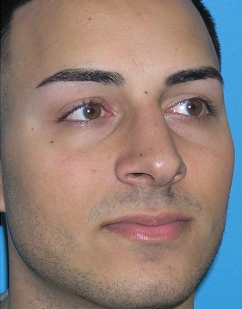 Favorite Male Rhinoplasty Before & After Gallery - Patient 338840 - Image 6