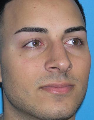 Favorite Male Rhinoplasty Before & After Gallery - Patient 338840 - Image 6