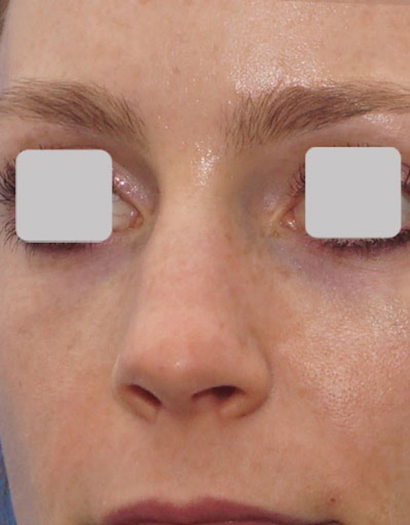 Revision Rhinoplasty Before & After Gallery - Patient 273927 - Image 5