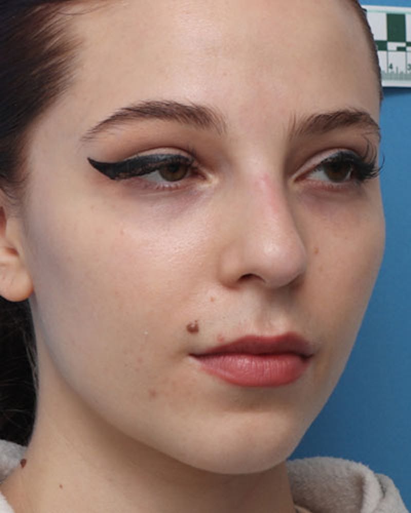 Rhinoplasty Before & After Gallery - Patient 258728 - Image 7