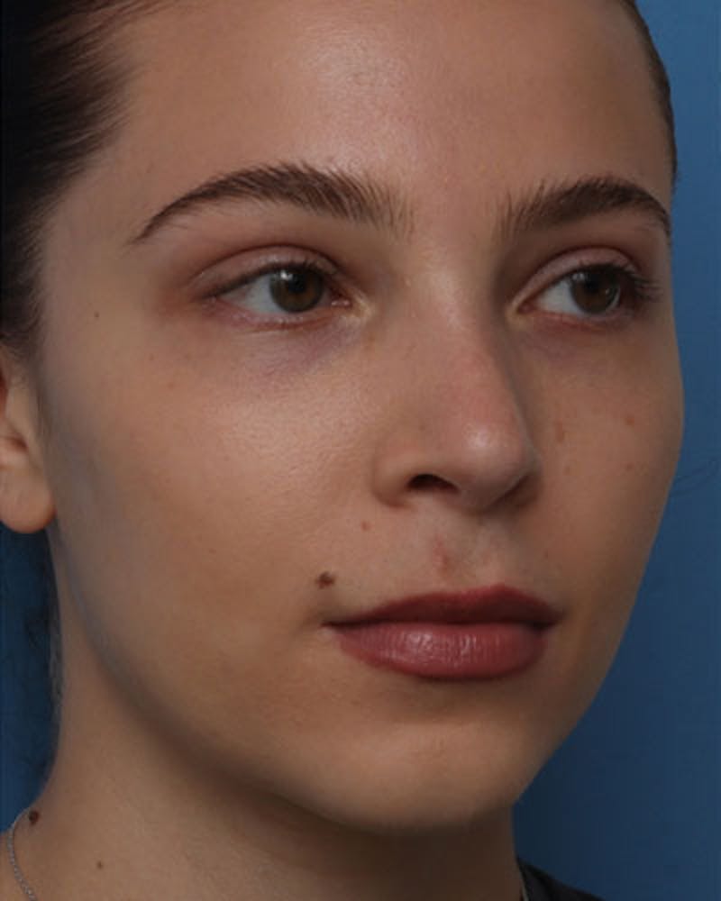 Rhinoplasty Before & After Gallery - Patient 258728 - Image 8