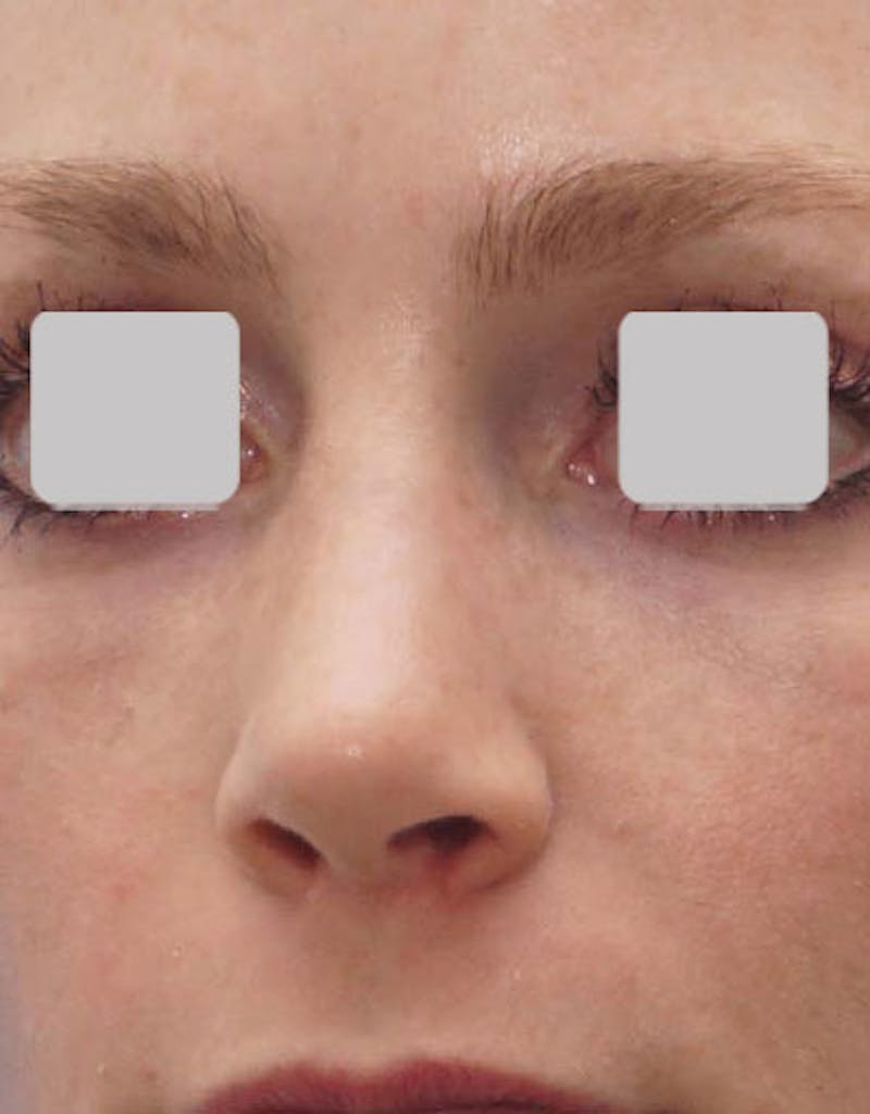 Favorite Revision Rhinoplasty Before & After Gallery - Patient 174327 - Image 6