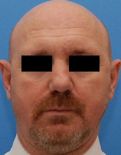 Rhinoplasty Before & After Gallery - Patient 425497 - Image 1