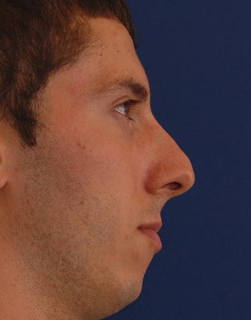 Patient XJ0w1QqvTc-LZIZLsEN89Q - Male Rhinoplasty Before & After Photos