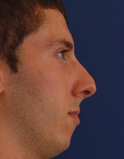 Rhinoplasty Before & After Gallery - Patient 353926 - Image 1