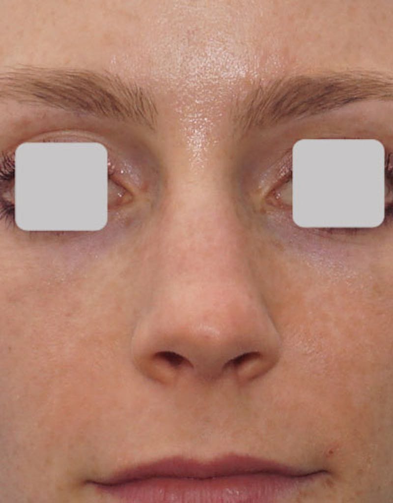 Favorite Revision Rhinoplasty Before & After Gallery - Patient 174327 - Image 7