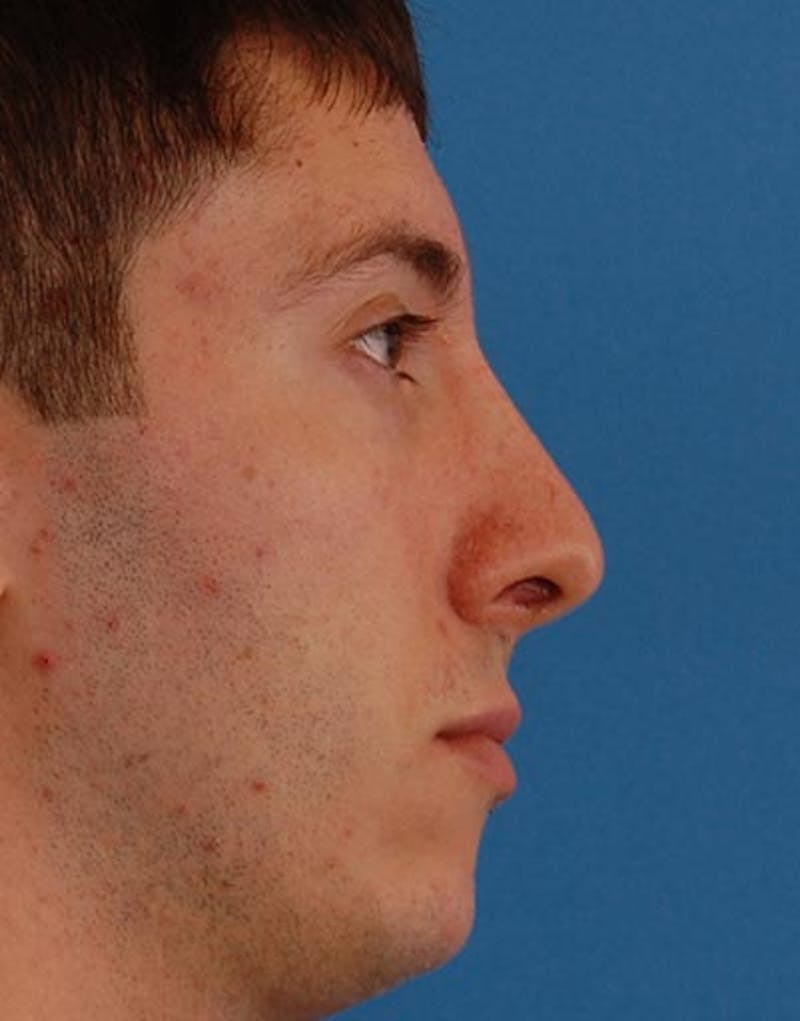 Male Rhinoplasty Before & After Gallery - Patient 257569 - Image 2