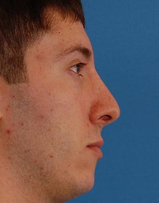 Rhinoplasty Before & After Gallery - Patient 353926 - Image 2
