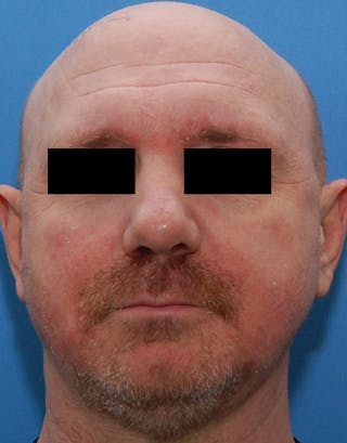 Rhinoplasty Before & After Gallery - Patient 425497 - Image 2