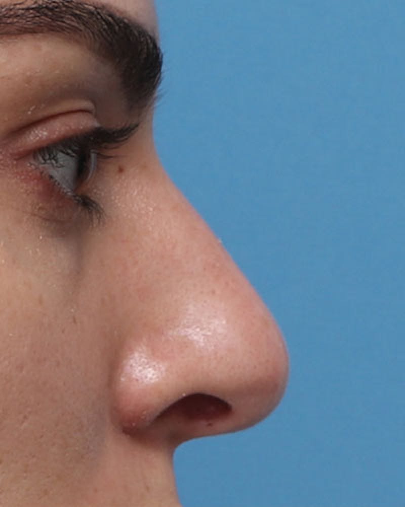 Rhinoplasty Before & After Gallery - Patient 137596 - Image 1