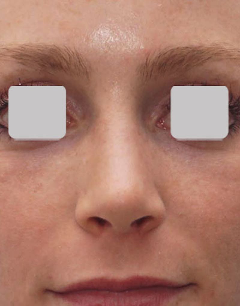 Favorite Revision Rhinoplasty Before & After Gallery - Patient 174327 - Image 8