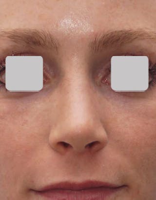 Favorite Revision Rhinoplasty Before & After Gallery - Patient 174327 - Image 8