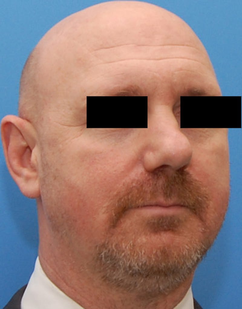 Rhinoplasty  Before & After Gallery - Patient 425497 - Image 3