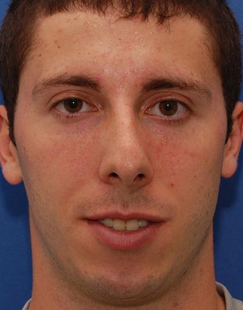 Rhinoplasty  Before & After Gallery - Patient 353926 - Image 3