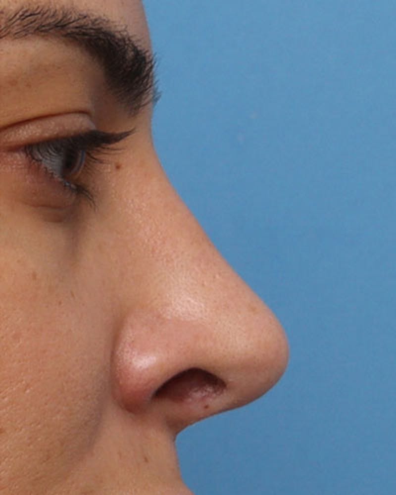 Rhinoplasty Before & After Gallery - Patient 137596 - Image 2