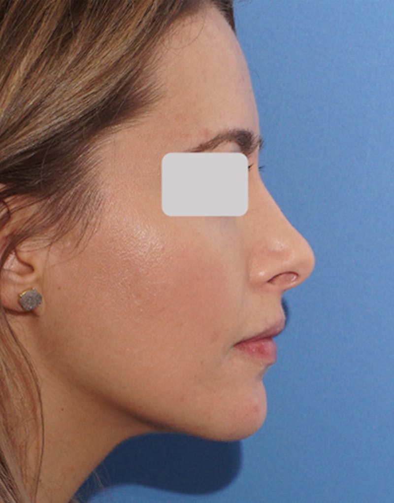 Revision Rhinoplasty Before & After Gallery - Patient 333874 - Image 1