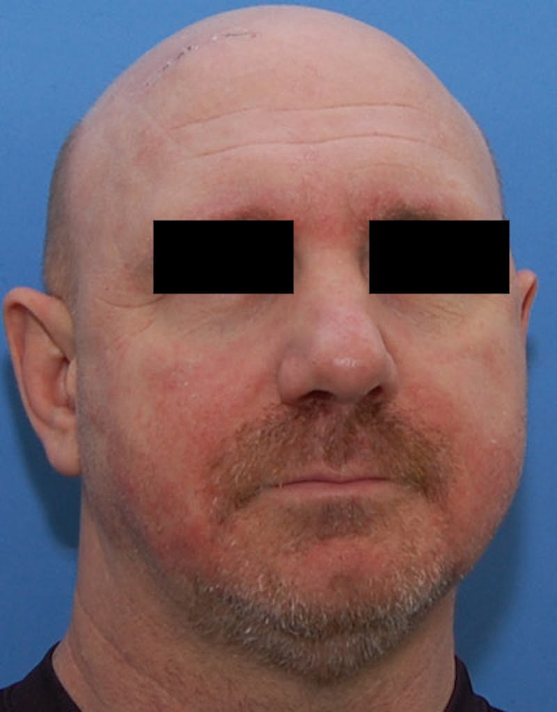 Rhinoplasty  Before & After Gallery - Patient 425497 - Image 4