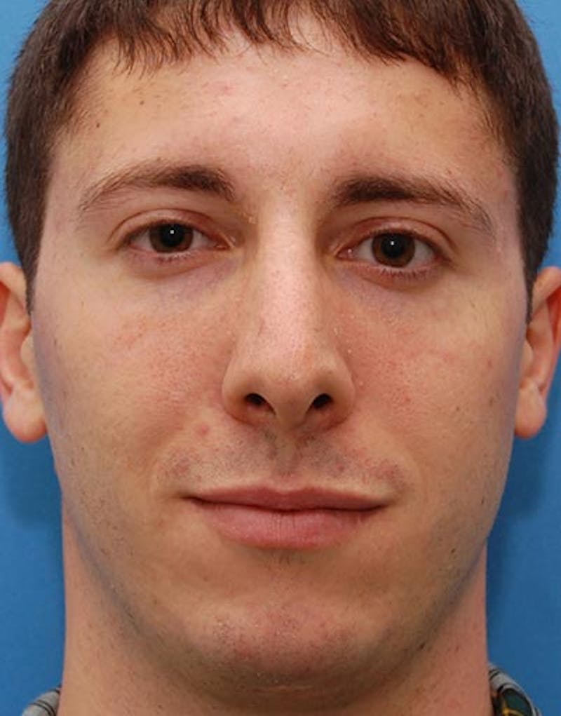 Male Rhinoplasty Before & After Gallery - Patient 257569 - Image 4