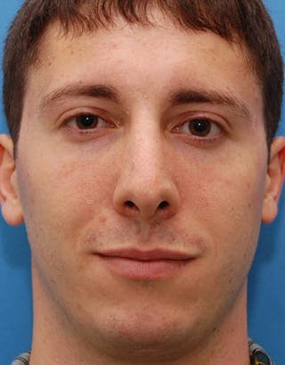 Rhinoplasty Before & After Gallery - Patient 353926 - Image 4