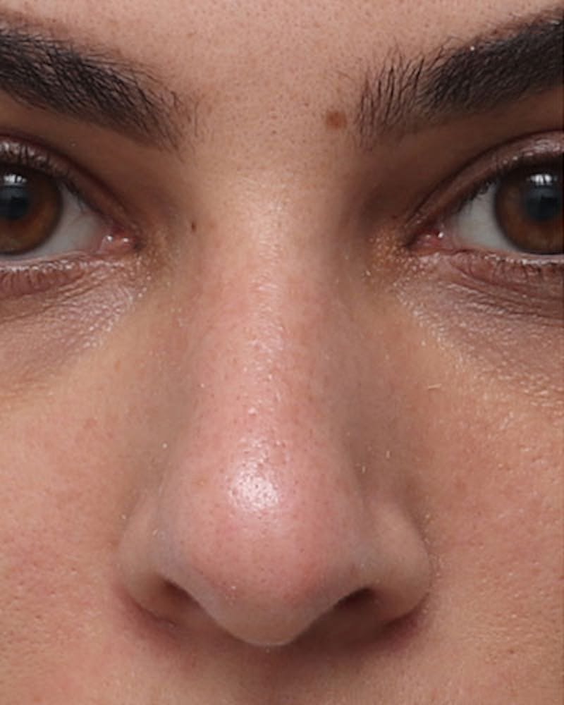 Rhinoplasty Before & After Gallery - Patient 137596 - Image 3