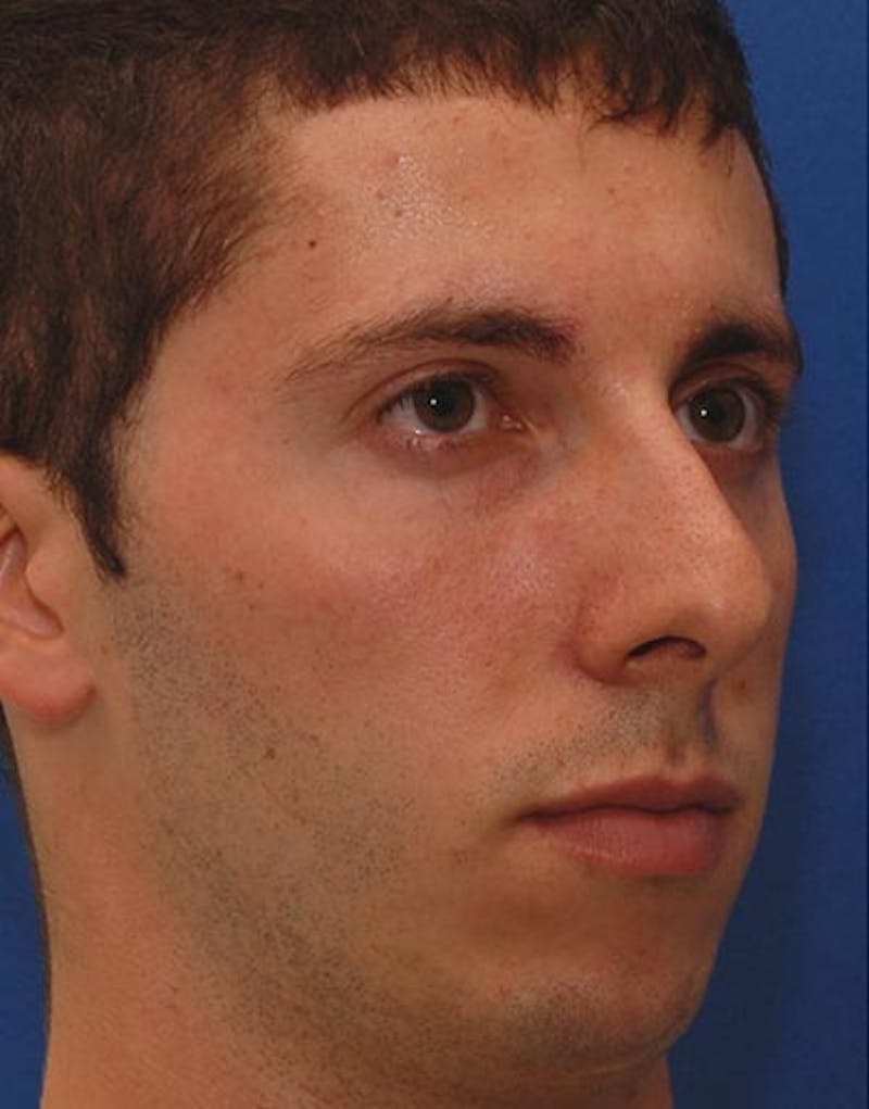 Male Rhinoplasty Before & After Gallery - Patient 257569 - Image 5