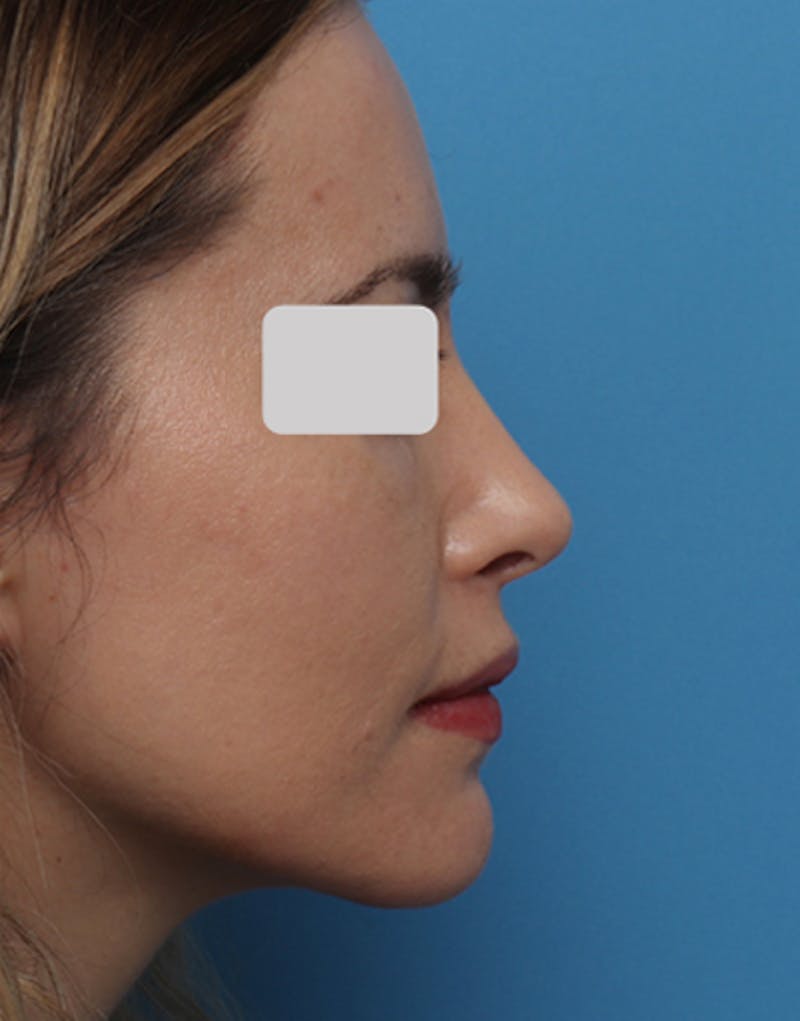 Revision Rhinoplasty Before & After Gallery - Patient 333874 - Image 2