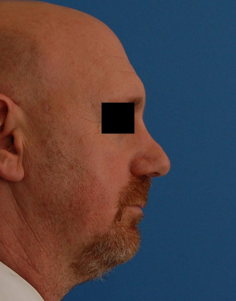Foundation Rhinoplasty / Crooked Nose Before & After Gallery - Patient 117917 - Image 5