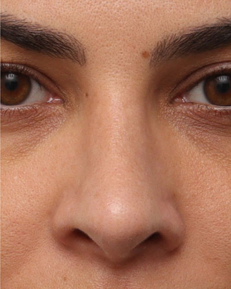 Rhinoplasty Before & After Gallery - Patient 137596 - Image 4