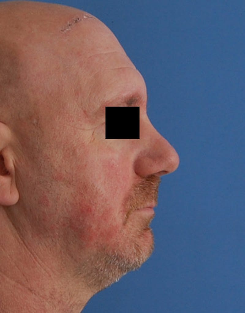 Rhinoplasty  Before & After Gallery - Patient 425497 - Image 6