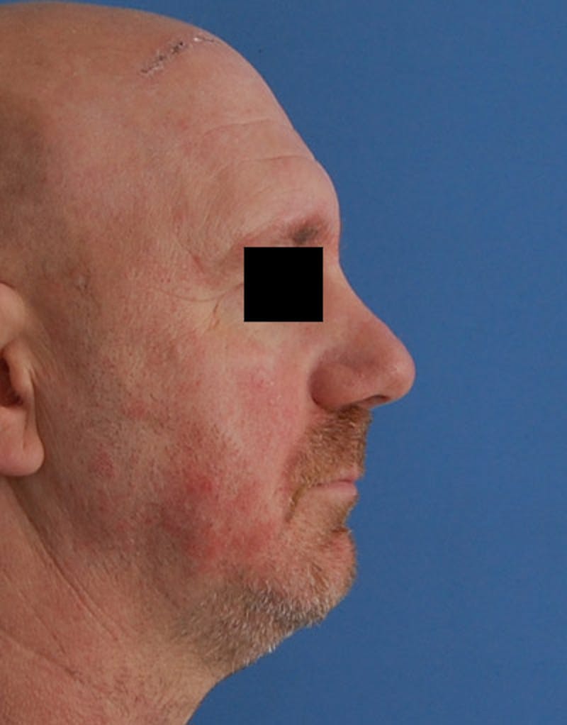 Foundation Rhinoplasty / Crooked Nose Before & After Gallery - Patient 117917 - Image 6