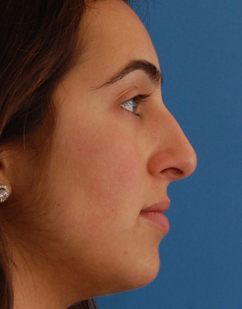 Rhinoplasty Before & After Gallery - Patient 383421 - Image 1