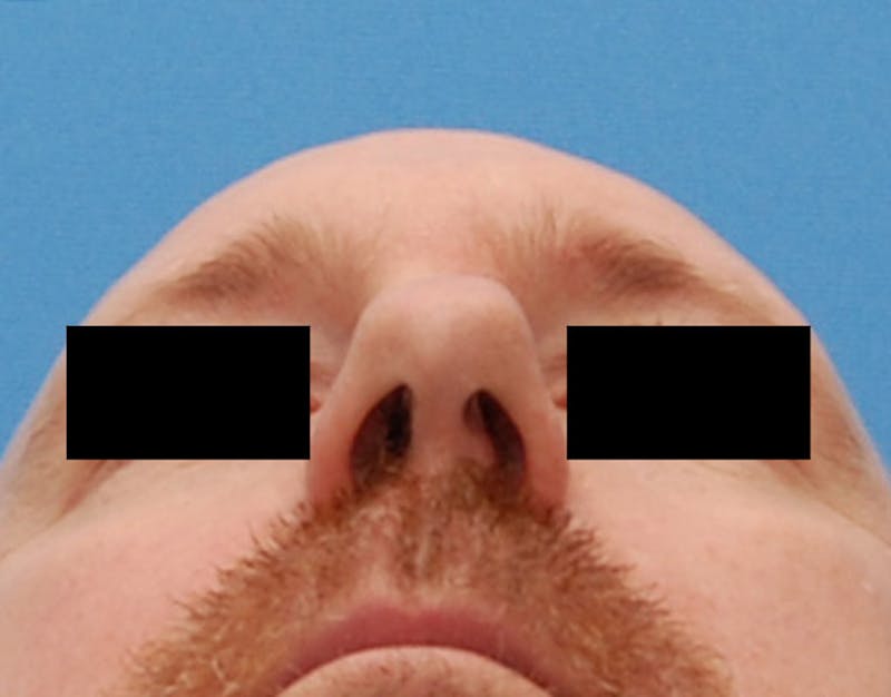 Foundation Rhinoplasty / Crooked Nose Before & After Gallery - Patient 117917 - Image 7