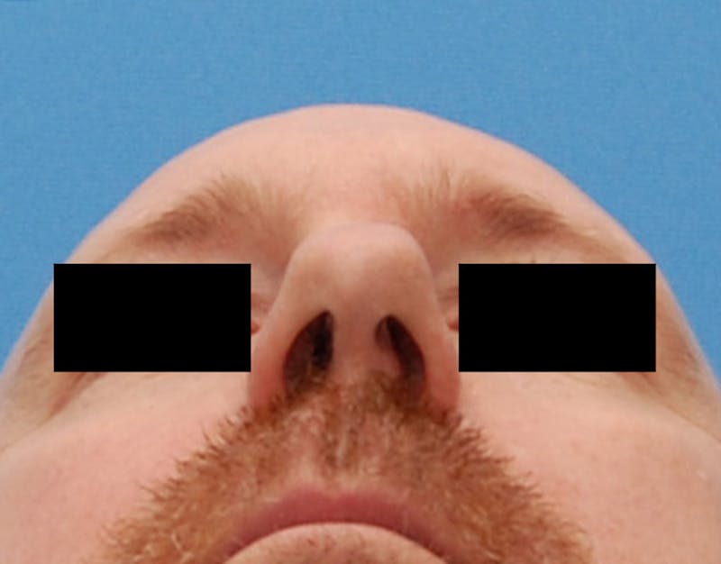 Rhinoplasty  Before & After Gallery - Patient 425497 - Image 7