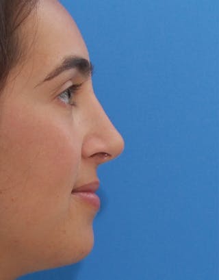Rhinoplasty Before & After Gallery - Patient 333309 - Image 2
