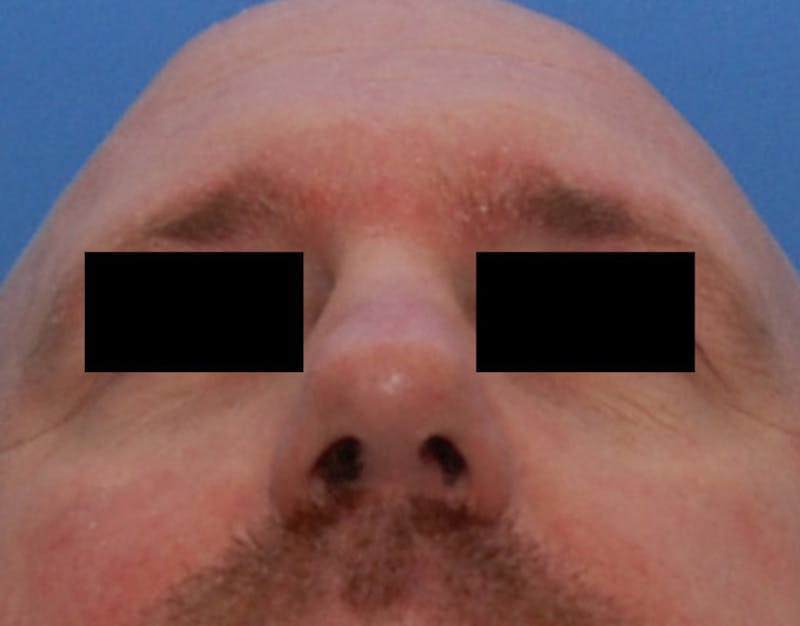 Foundation Rhinoplasty / Crooked Nose Before & After Gallery - Patient 117917 - Image 8