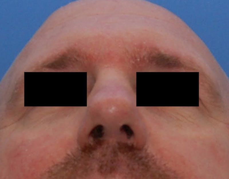 Rhinoplasty  Before & After Gallery - Patient 425497 - Image 8
