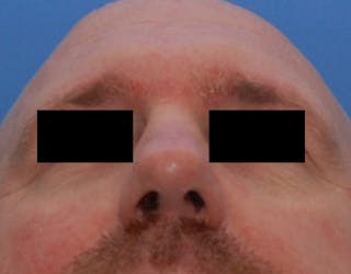 Rhinoplasty Before & After Gallery - Patient 425497 - Image 8