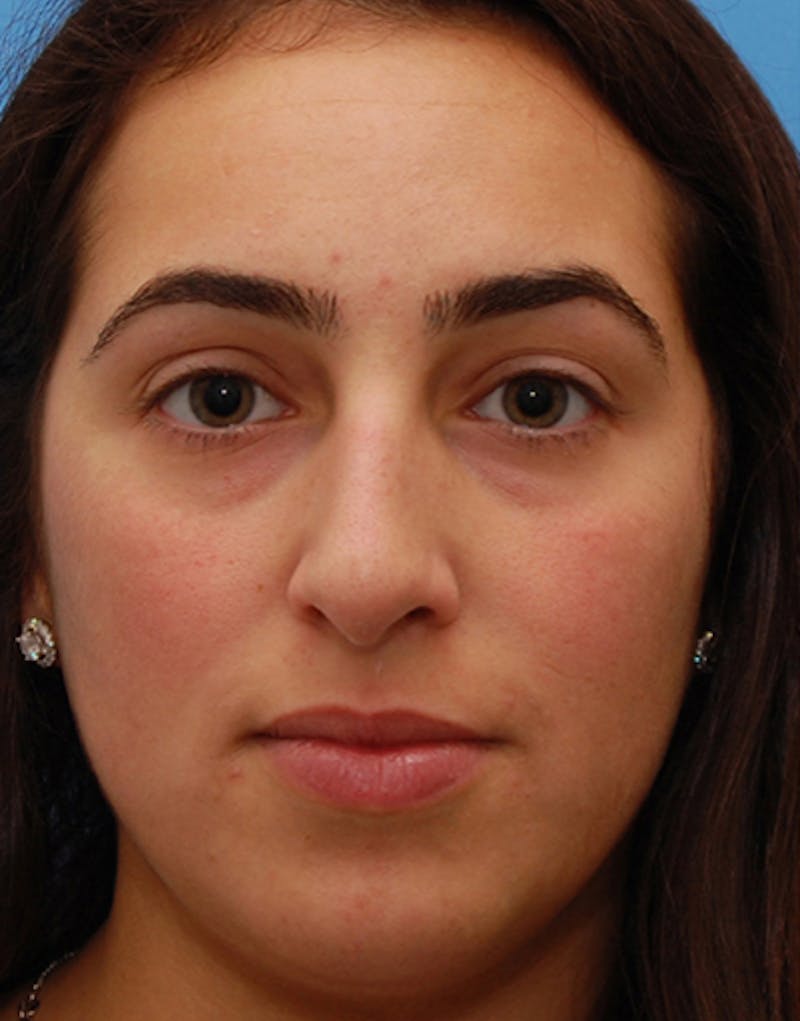 Rhinoplasty Before & After Gallery - Patient 383421 - Image 3