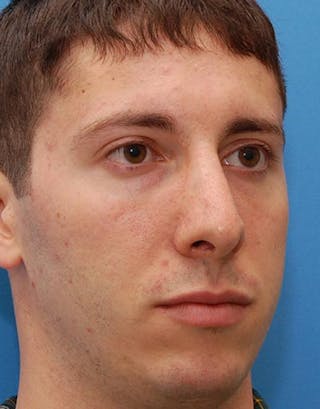 Rhinoplasty Before & After Gallery - Patient 353926 - Image 6