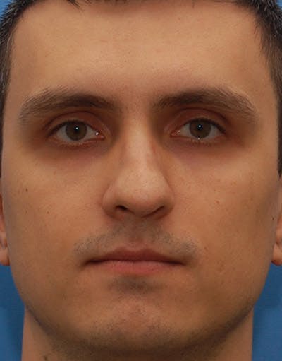 Rhinoplasty Before & After Gallery - Patient 387643 - Image 1