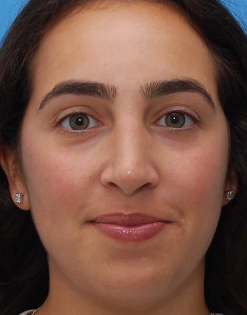 Rhinoplasty  Before & After Gallery - Patient 333309 - Image 4