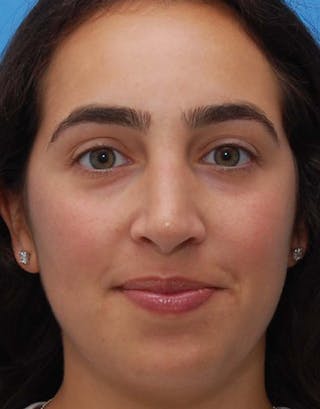 Rhinoplasty Before & After Gallery - Patient 333309 - Image 4