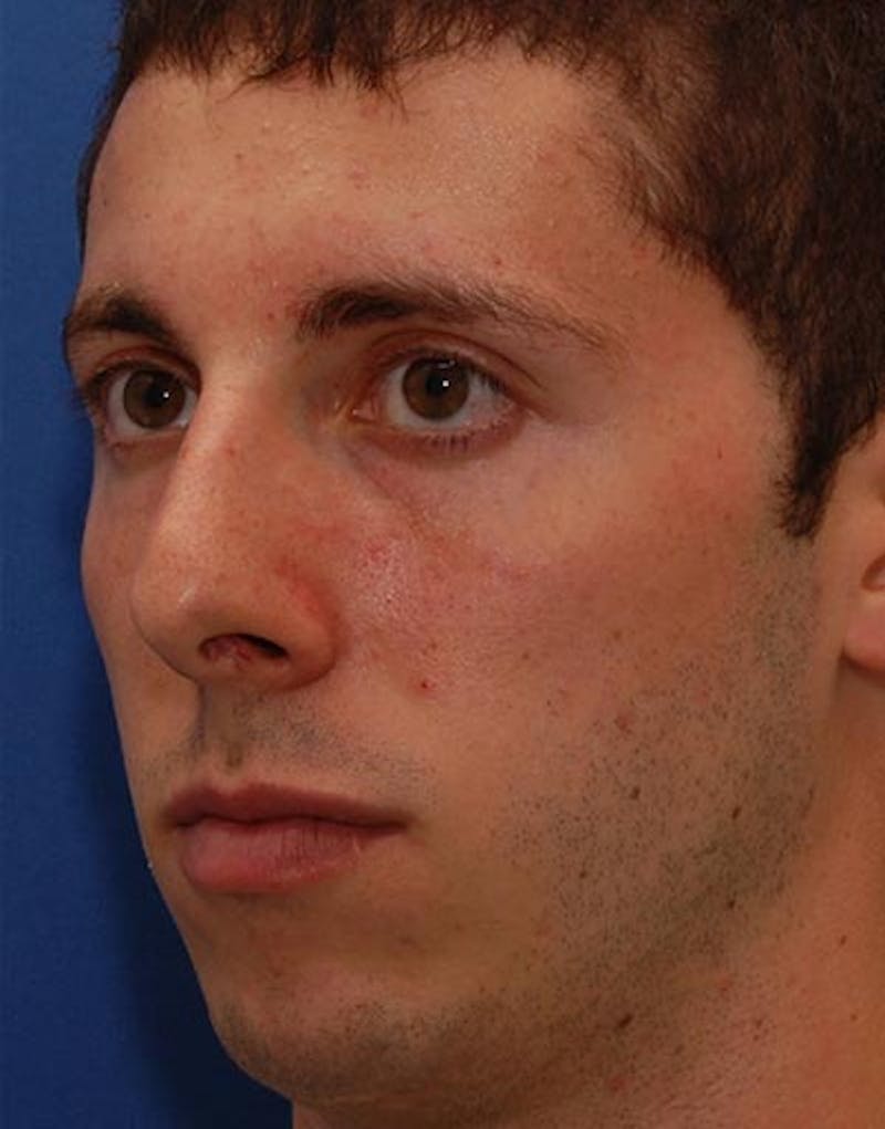 Male Rhinoplasty Before & After Gallery - Patient 257569 - Image 7