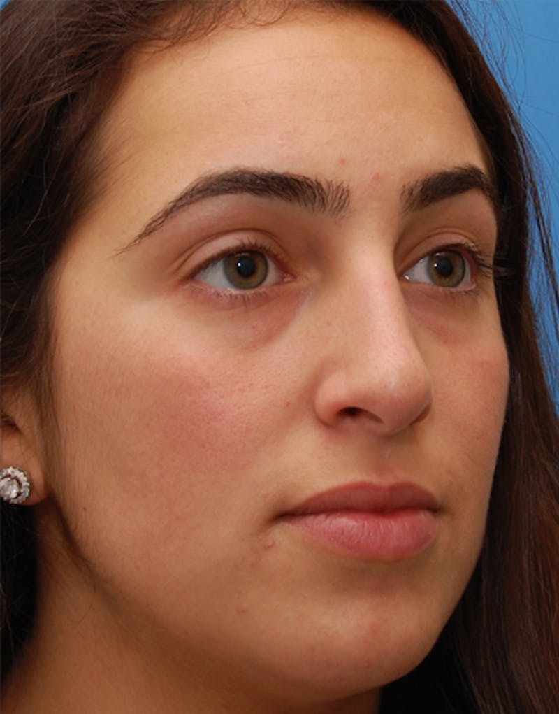 Rhinoplasty Before & After Gallery - Patient 383421 - Image 5