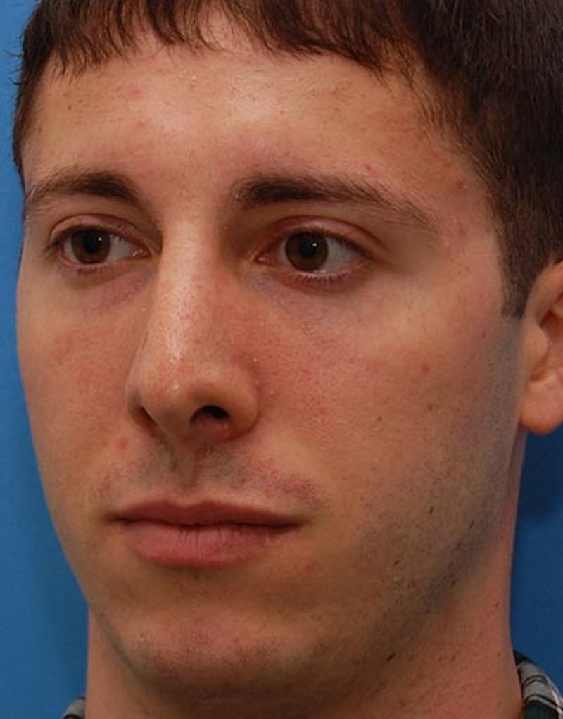 Male Rhinoplasty Before & After Gallery - Patient 257569 - Image 8