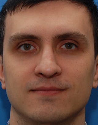 Rhinoplasty Before & After Gallery - Patient 387643 - Image 2