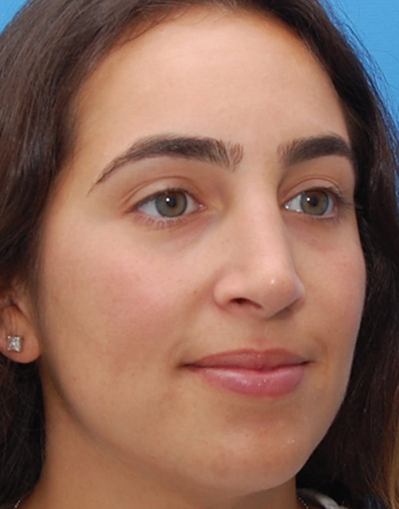 Rhinoplasty  Before & After Gallery - Patient 333309 - Image 6