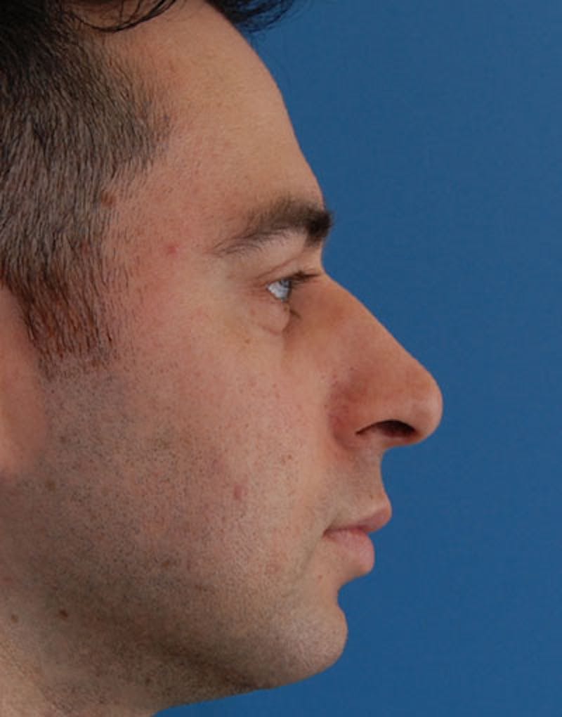 Male Rhinoplasty Before & After Gallery - Patient 123470 - Image 1