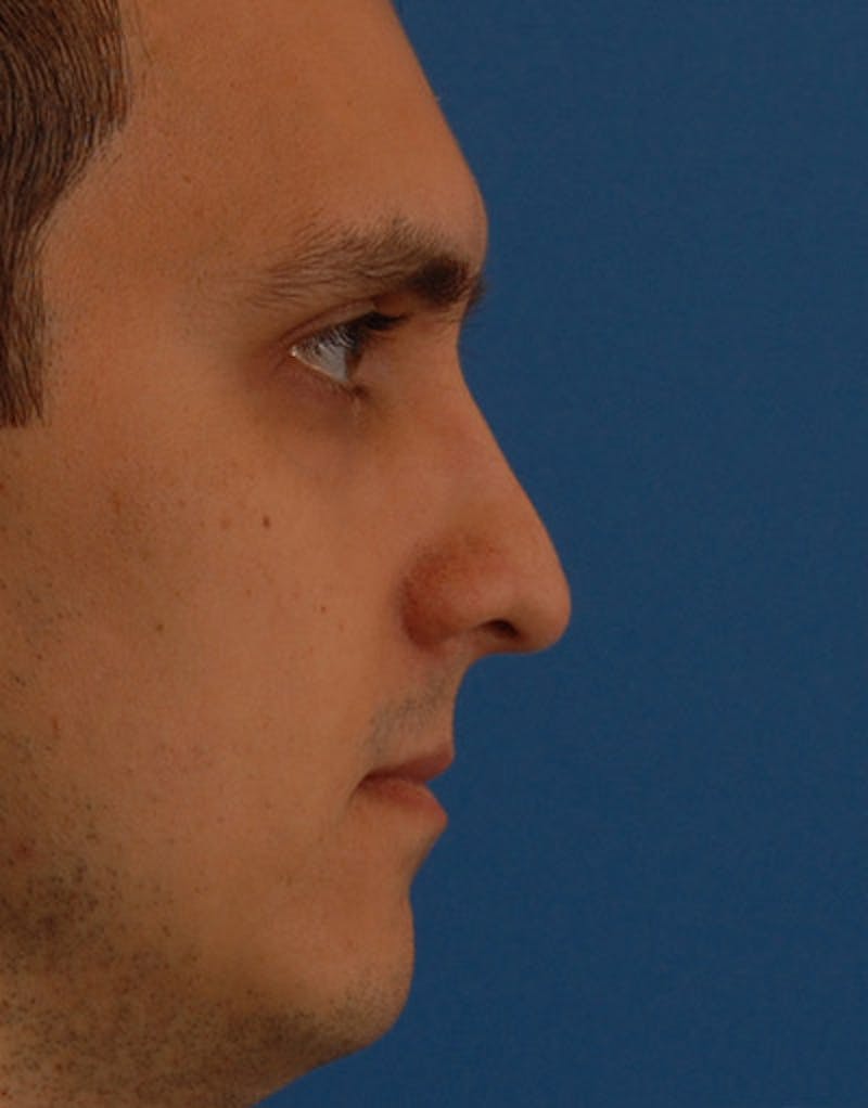 Foundation Rhinoplasty / Crooked Nose Before & After Gallery - Patient 128754 - Image 3